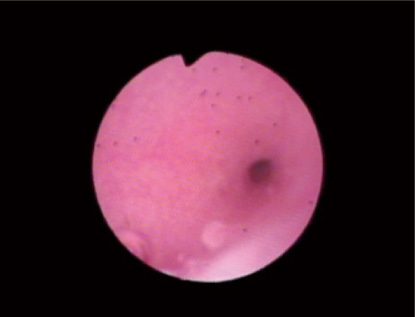 子宮鏡検査での映像1